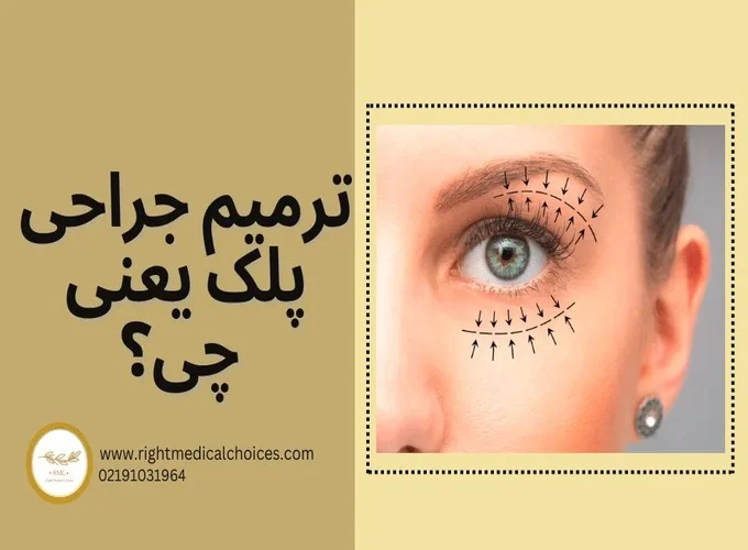ترمیم جراحی پلک در تهران و بهترین جراح آن در سال ۱۴۰۵