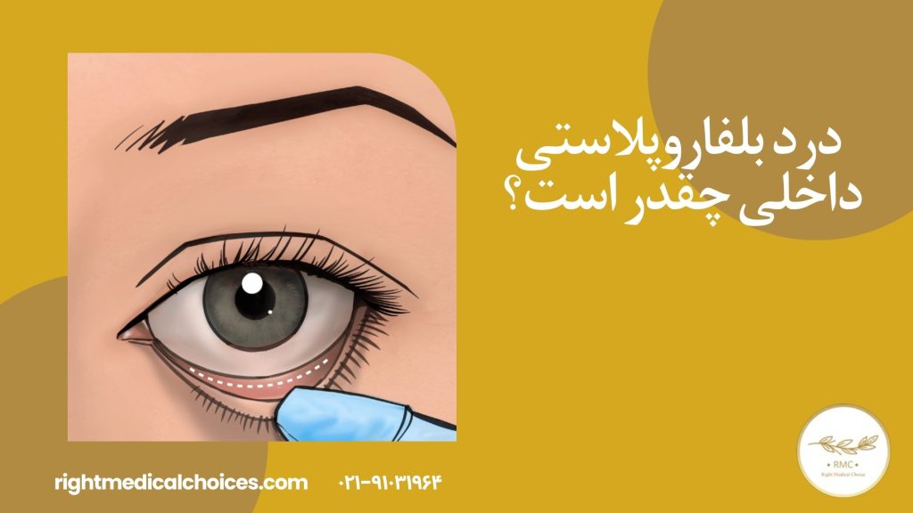 درد بلفاروپلاستی داخلی چقدر است؟ تجربه واقعی بیماران + طول دوره درد و راه‌های کاهش آن