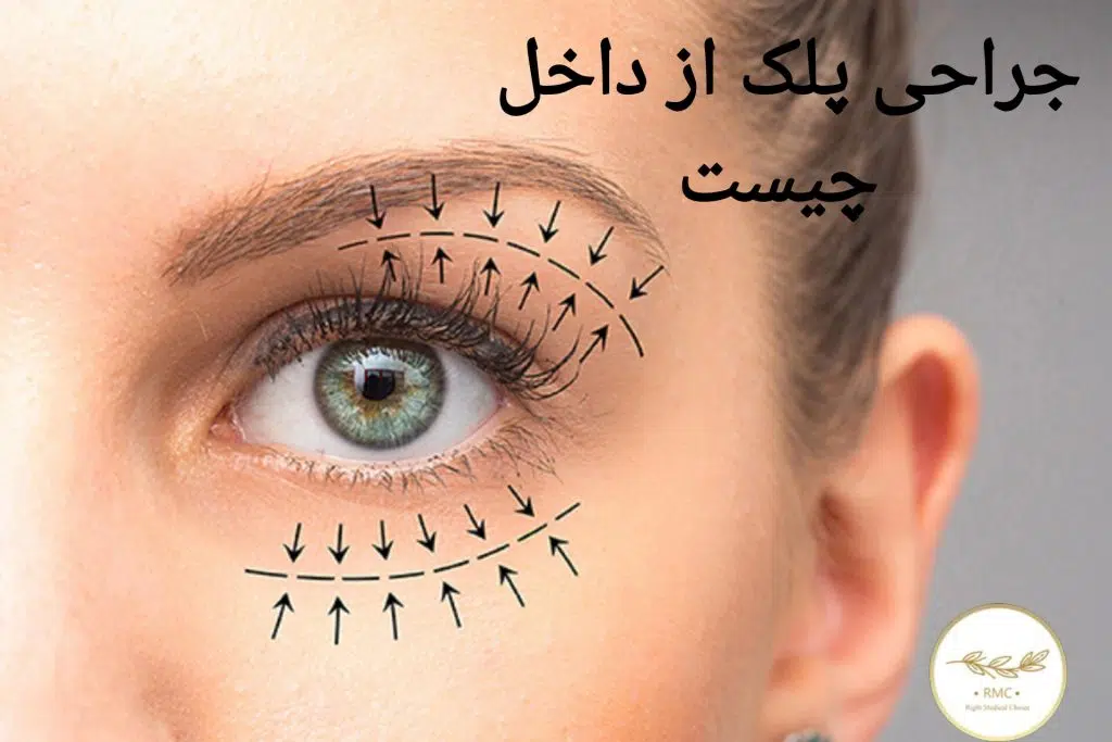 آیا جراحی پلک از داخل نیاز به بیهوشی دارد؟