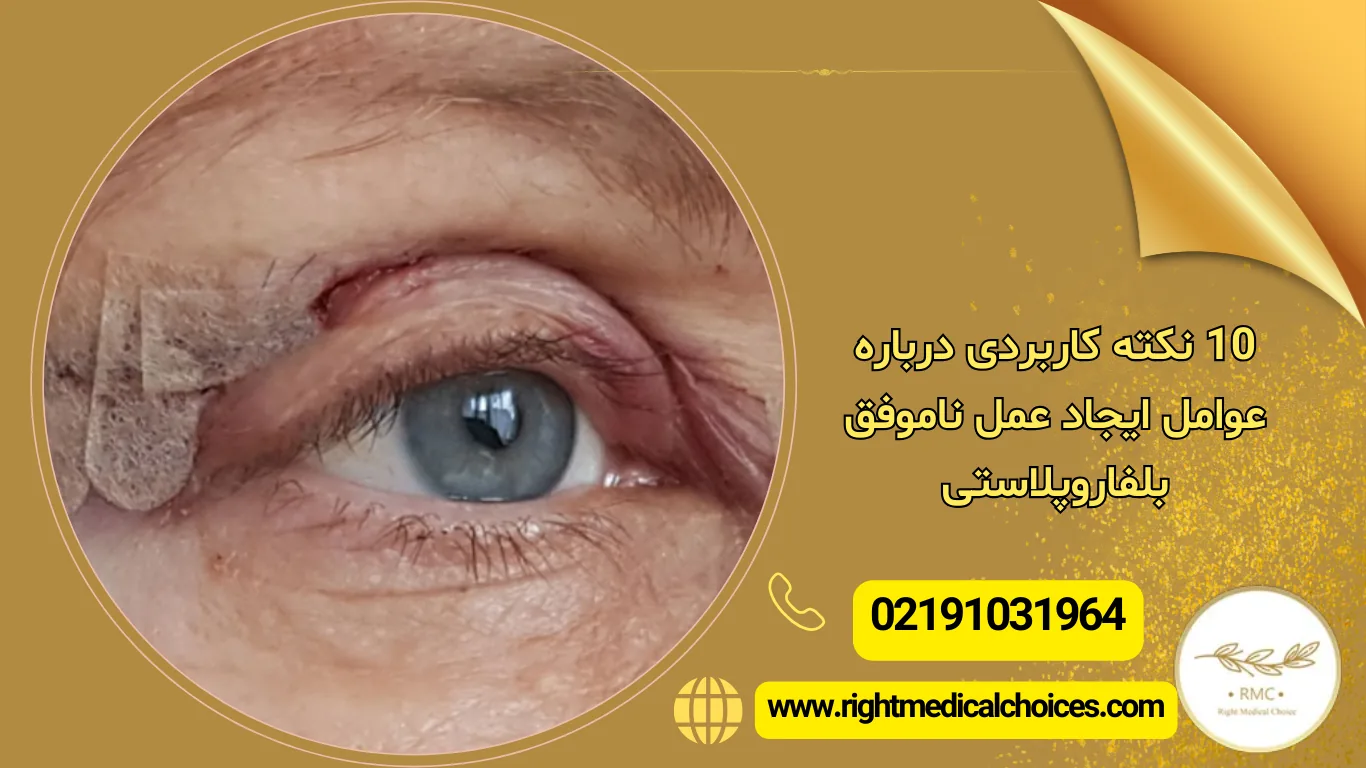 عمل ناموفق بلفاروپلاستی رو چطوری تشخیص بدم؟ ۱۰ نکته کاربردی