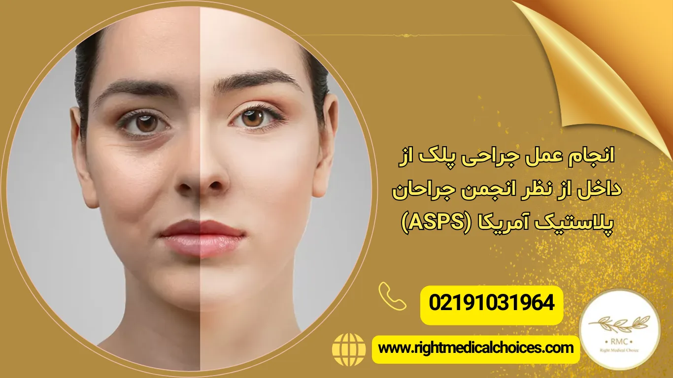 مناسب‌ترین سن برای جراحی پلک از داخل چیست؟ پاسخ متخصصان