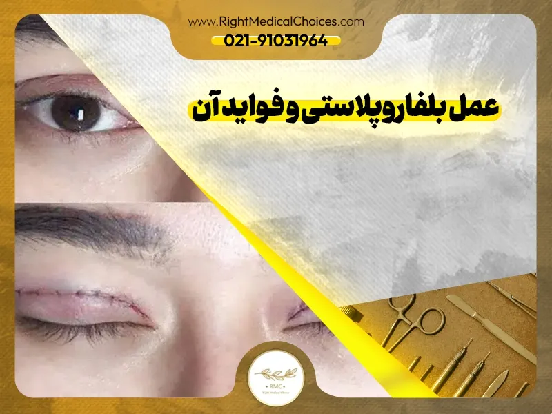 روش‌های موثر درمان اسکار بلفاروپلاستی: راهنمای جامع