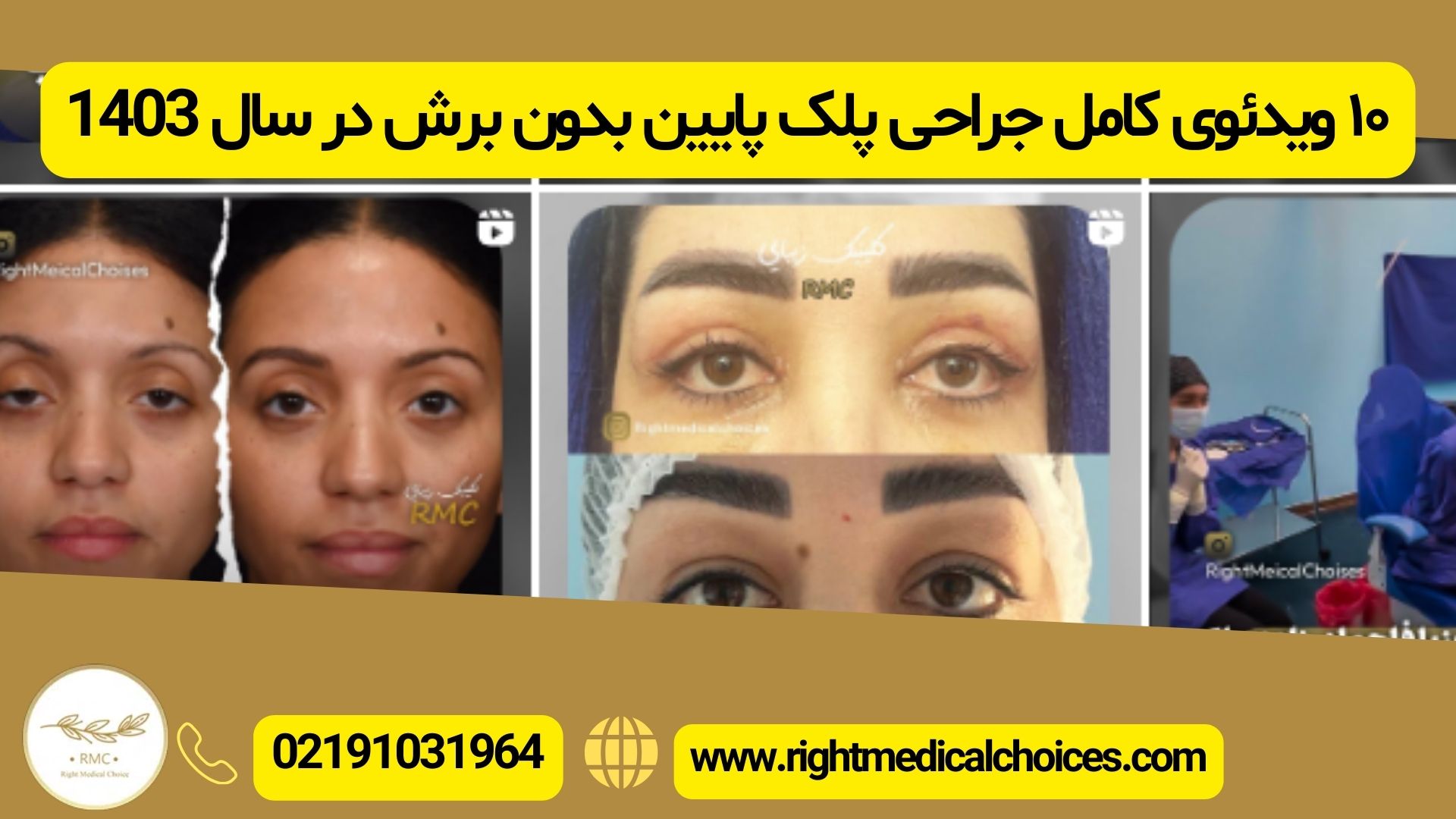 ۱۰ ویدئوی کامل جراحی پلک پایین بدون برش