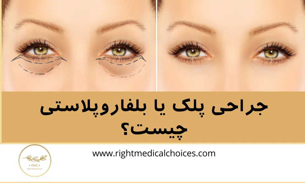 ۱۷ سوال متداول طلایی درباره جراحی پلک
