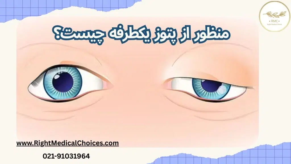 پتوز یکطرفه در مقایسه با پتوز دوطرفه: تفاوت‌ها و پروتکل‌های درمانی