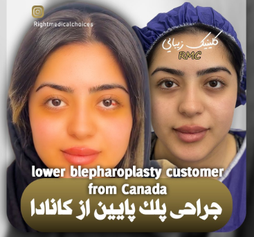 ۱۰ عکس شگفت‌انگیز از جراحی پلک پایین: نتایج واقعی را ببینید!