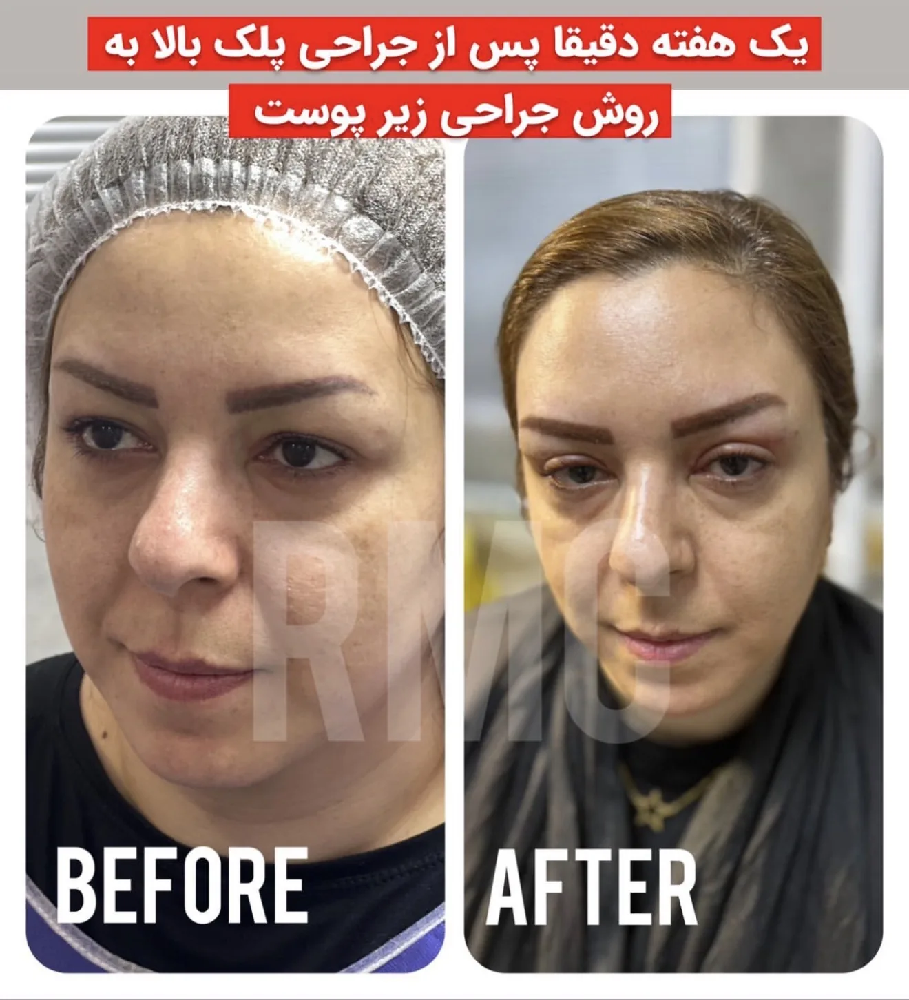 یک هفته پس از جراحی پلک بالا