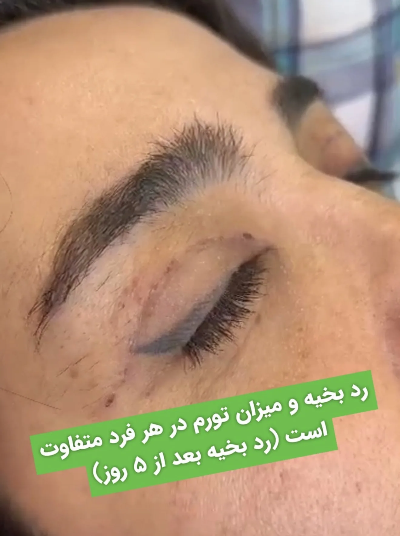 رد بخیه، ۵ روز پس از عمل