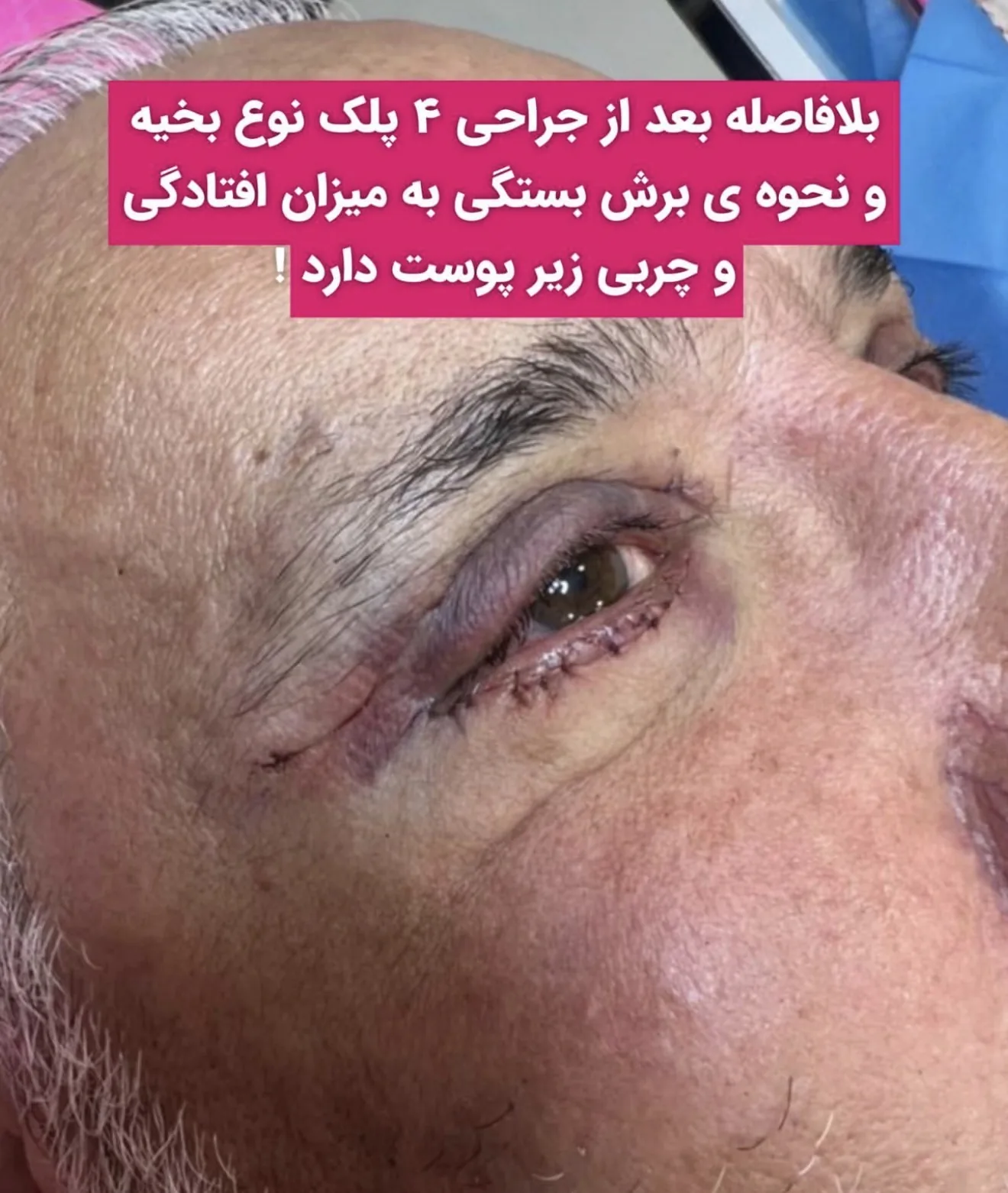 بلافاصله پس از جراحی چهار پلک