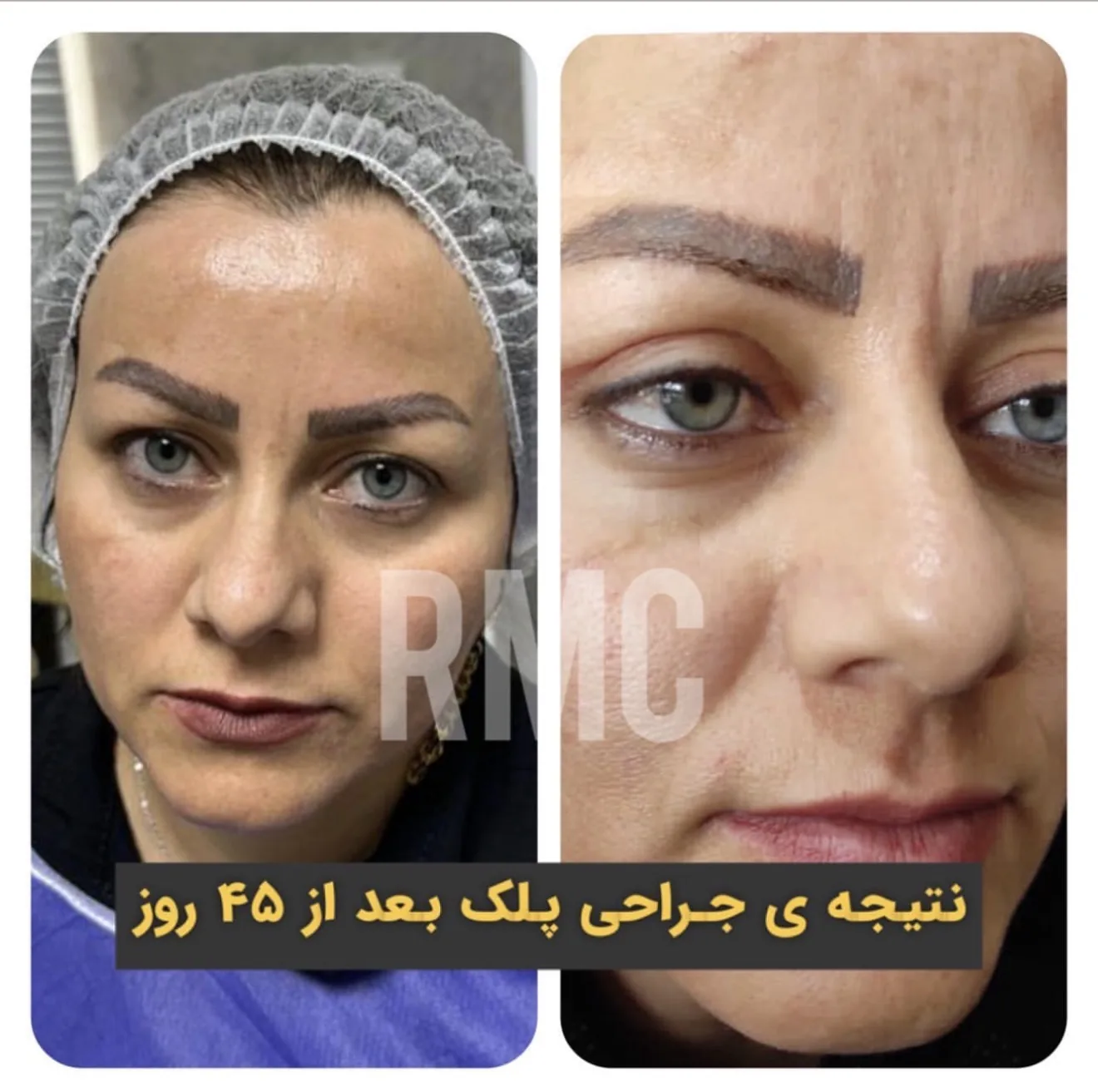 نتیجه جراحی پلک، ۴۵ روز بعد