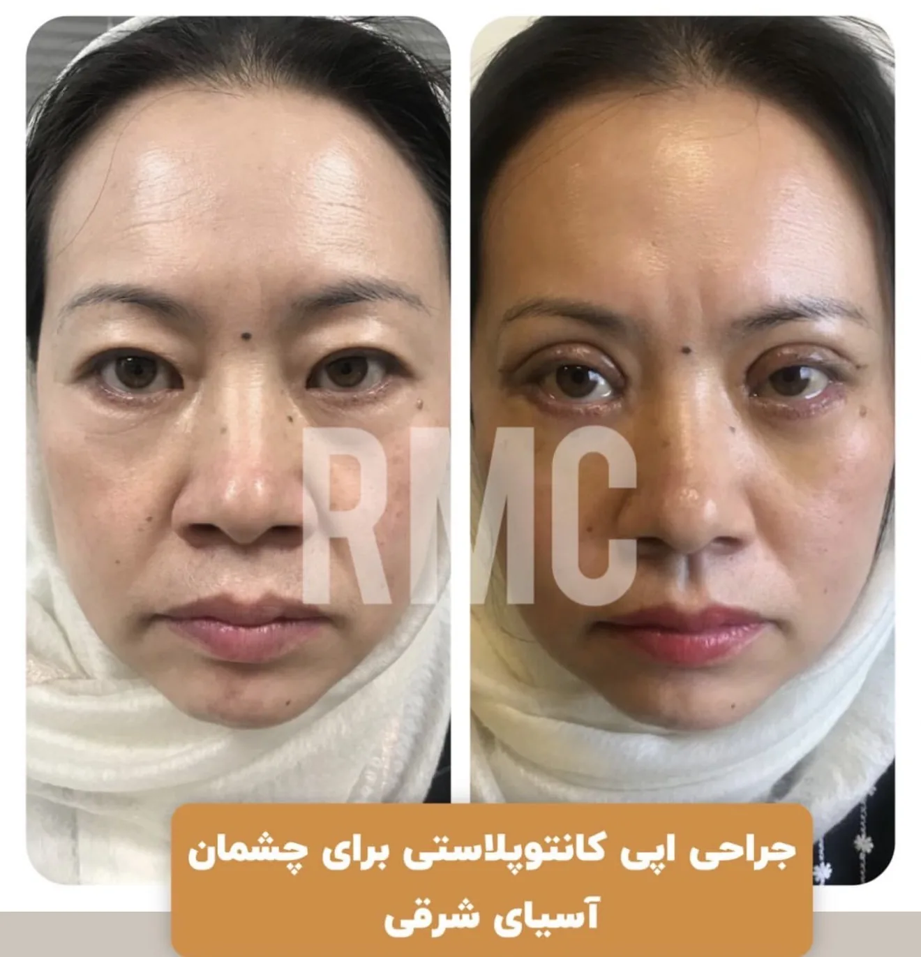 اپی‌کانتوپلاستی برای چشمان آسیای شرقی