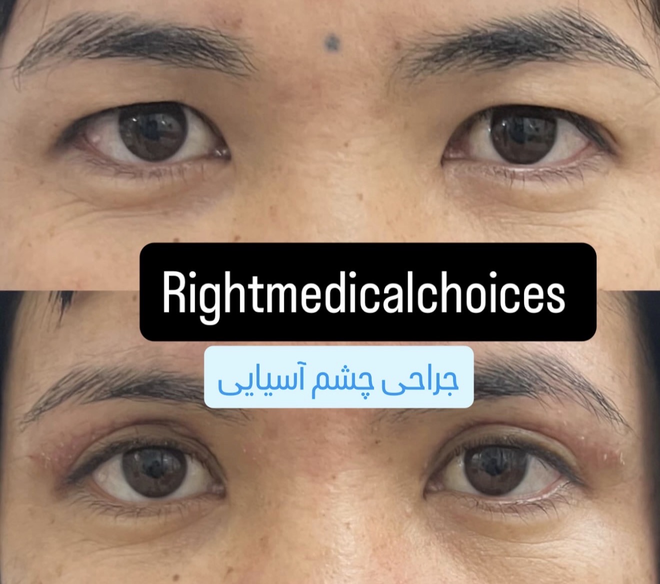 تفاوت جراحی چشم آسیایی