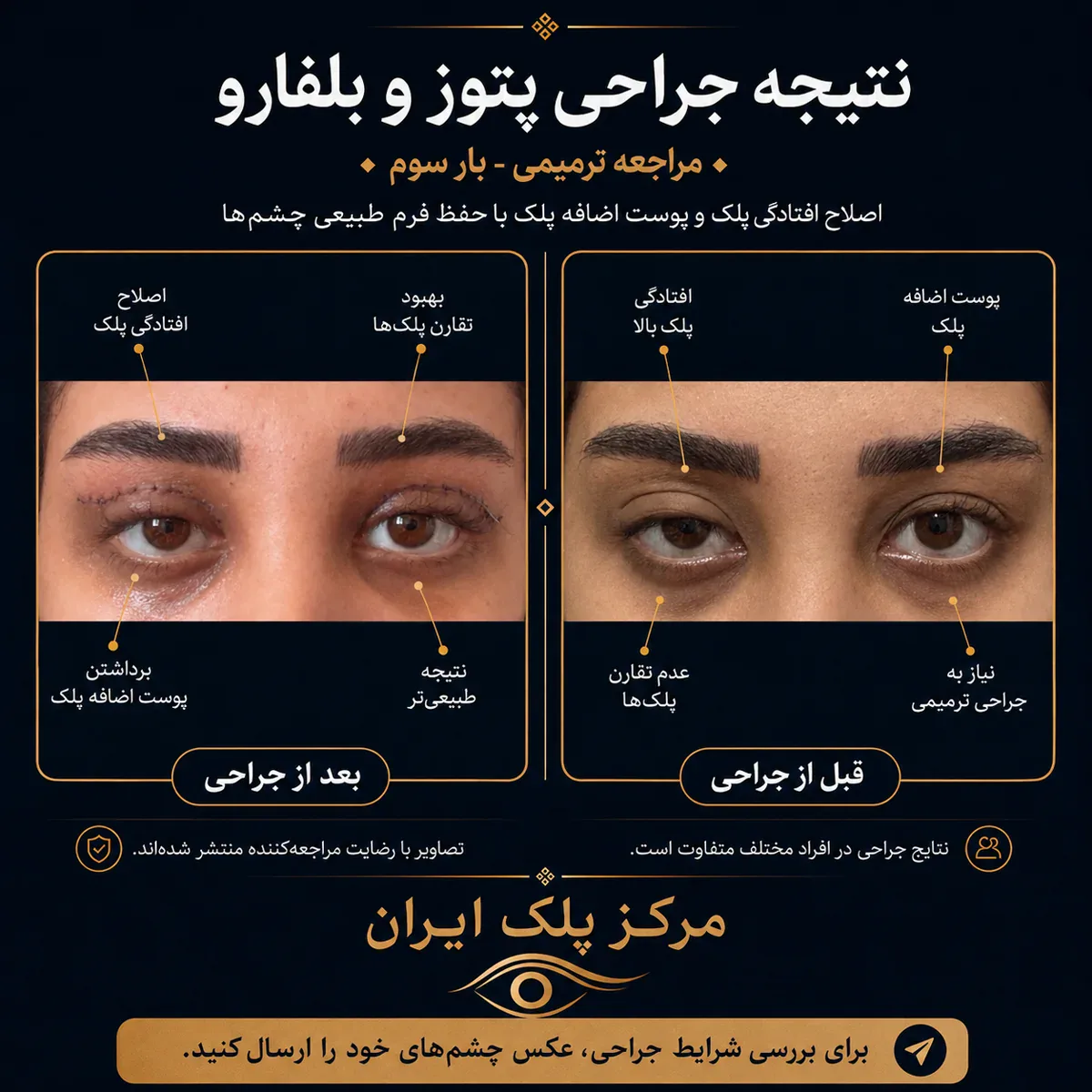 نتیجه جراحی پتوز و بلفاروپلاستی — مراجعه‌ی ترمیمی