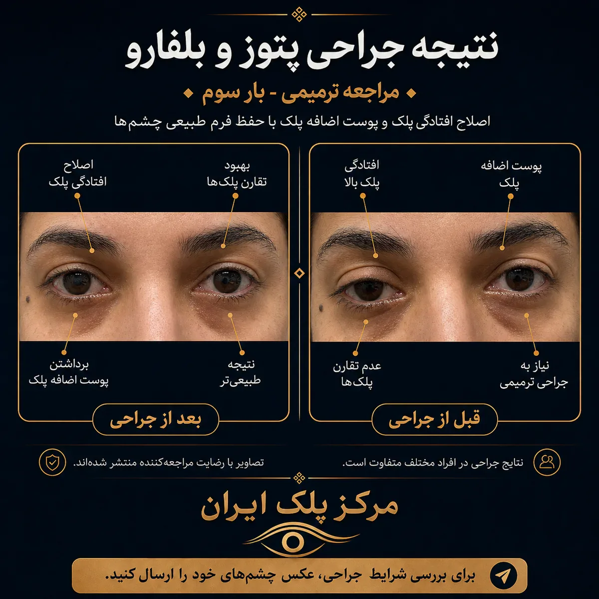 نتیجه جراحی پتوز و بلفاروپلاستی — مراجعه‌ی ترمیمی