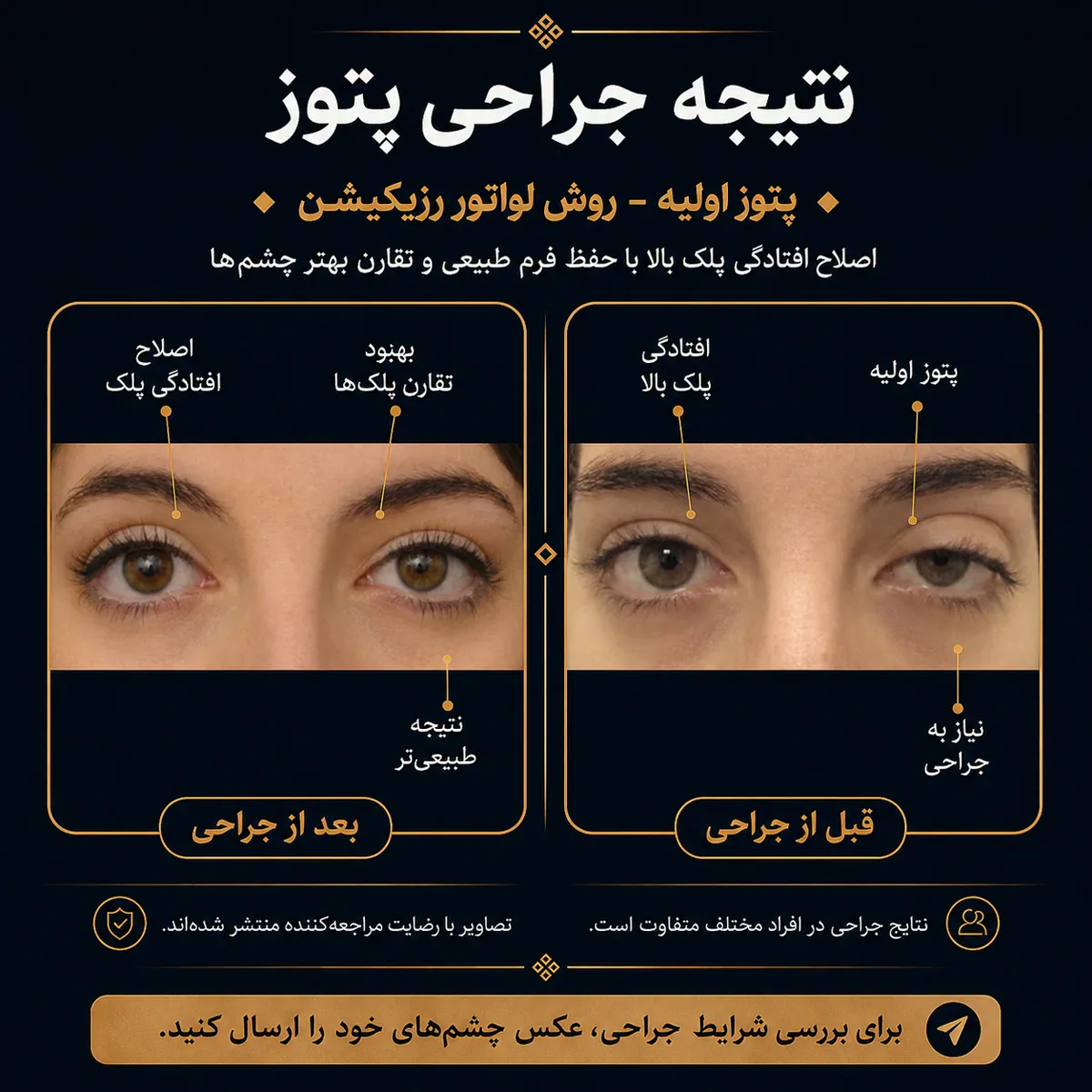 نتیجه جراحی پتوز — روش لواتور رزکشن