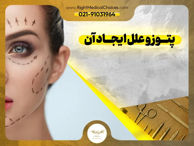 پتوز و علل ایجاد آن