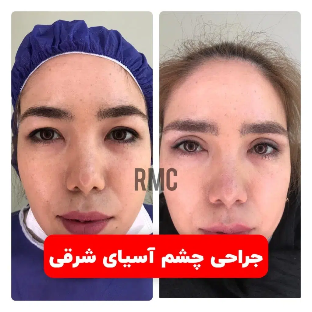مزایا و معایب جراحی اپی کانتوپلاستی