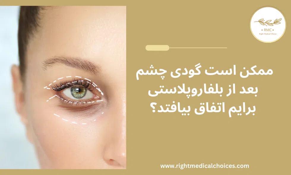 بعد از بلفاروپلاستی گودی چشم اتفاق میافتد؟