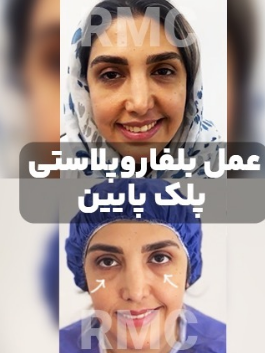 جراحی پلک پایین