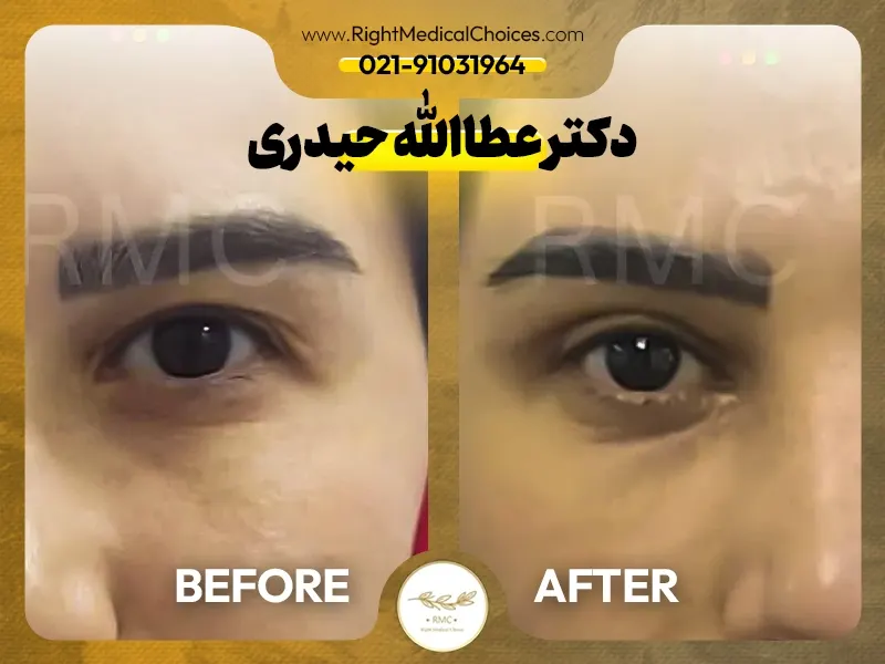 نمونه کار بلفاروپلاستی