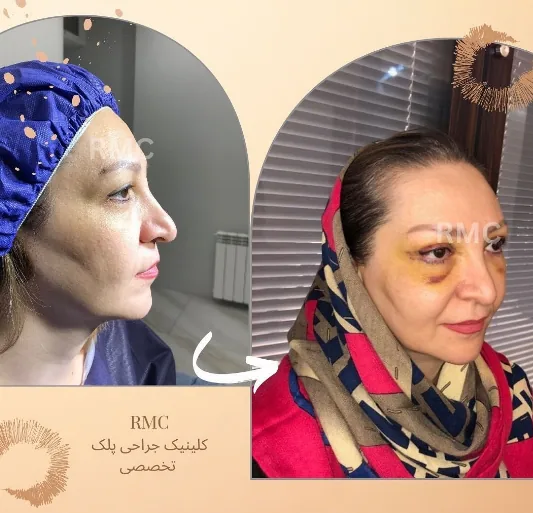 جراحی پلک پایین