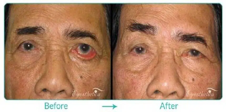 جراجی اکتروپیون