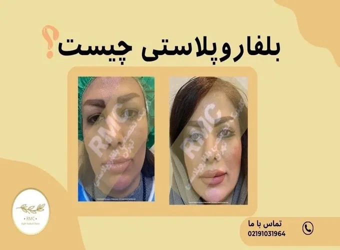 جراحی پلک (بلفاروپلاستی) و مزایای آن