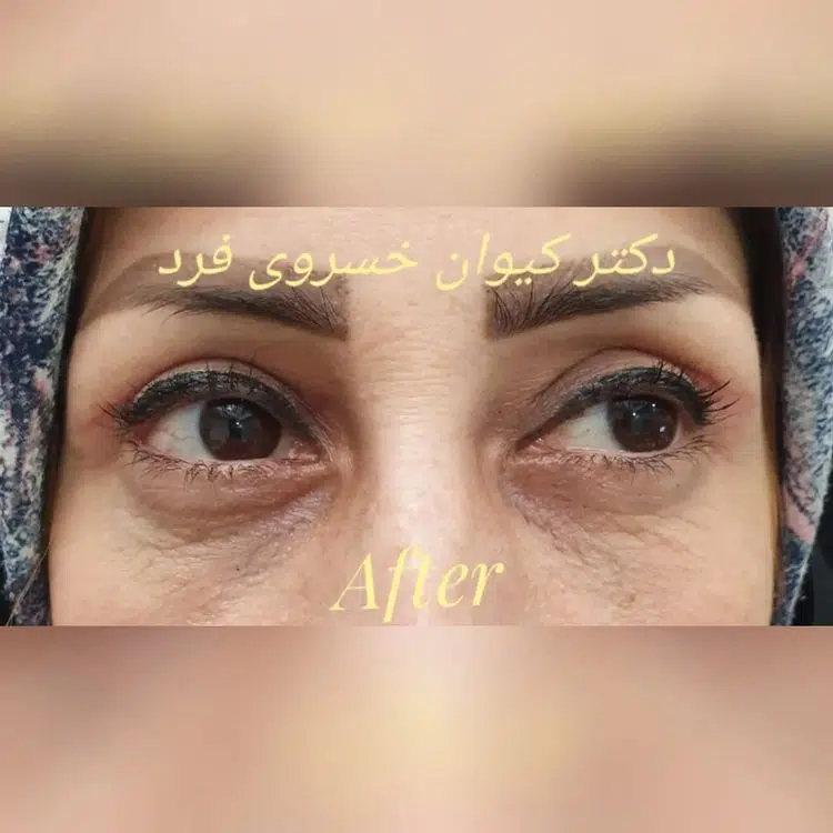بعد از بلفاروپلاستی چه شکلی می‌شیم؟ | دکتر کیوان خسروی فرد