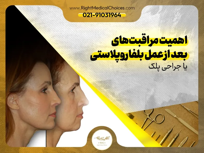 اهمیت مراقبت‌های بعد از عمل بلفاروپلاستی یا جراحی پلک