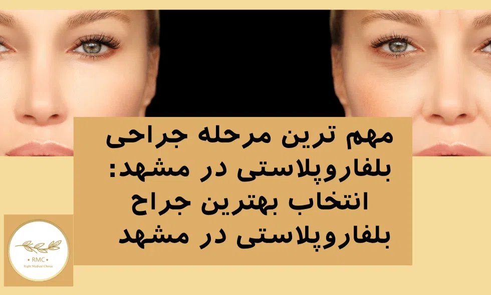 انتخاب بهترین جراح بلفاروپلاستی در مشهد