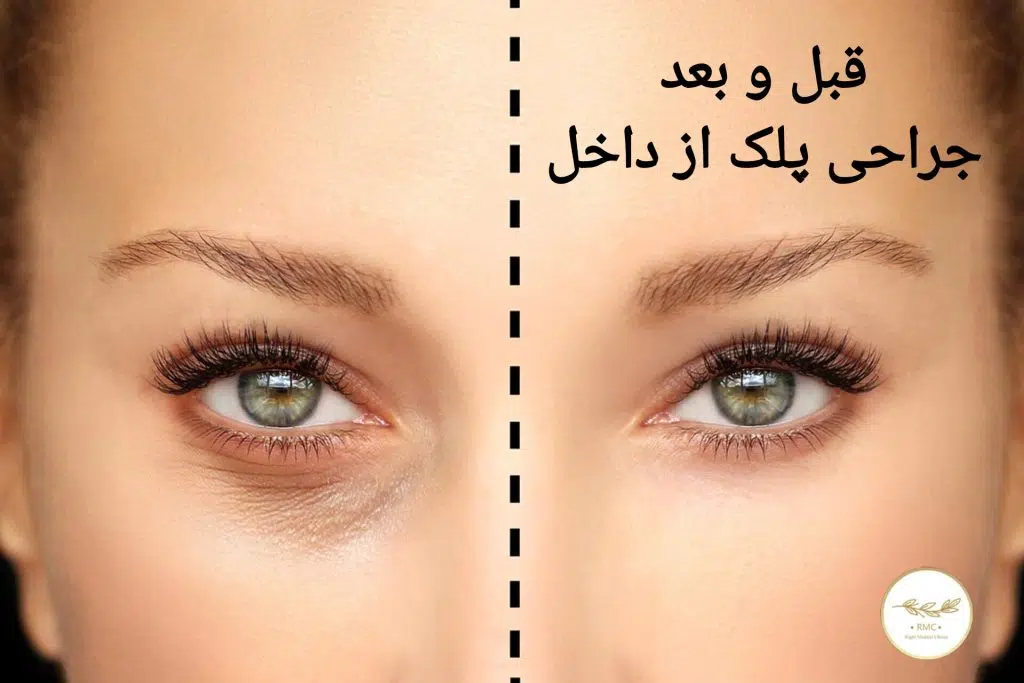 قبل و بعد جراحی پلک از داخل