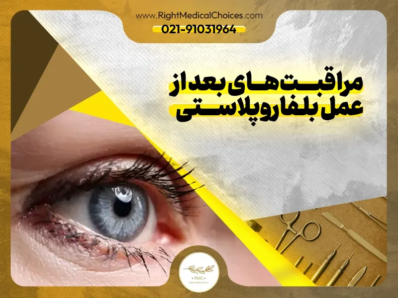 مراقبت‌های بعد از عمل بلفاروپلاستی