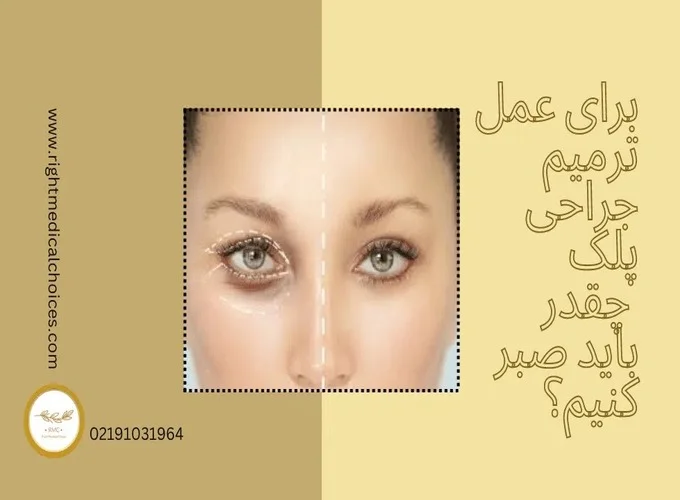 بهترین زمان عمل ترمیمی پلک بعد از بلفاروپلاستی اولیه