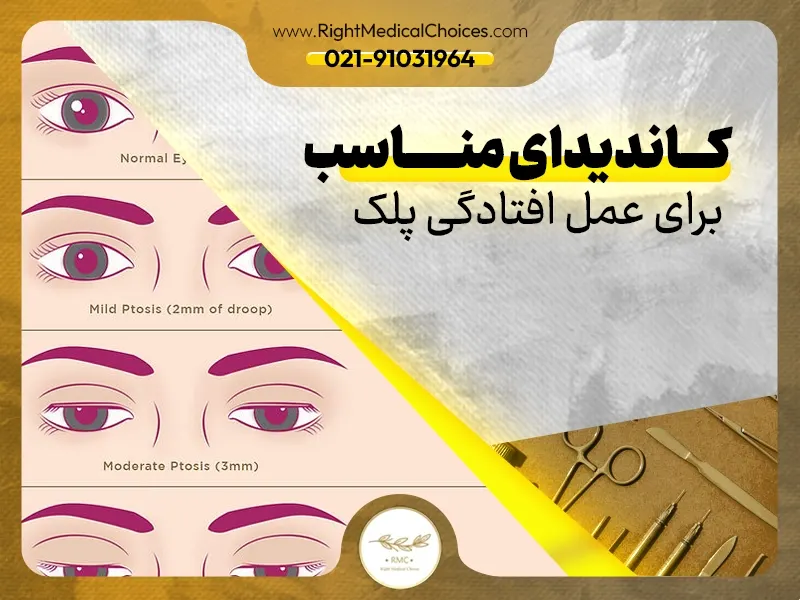 کاندیدای مناسب برای عمل افتادگی پلک