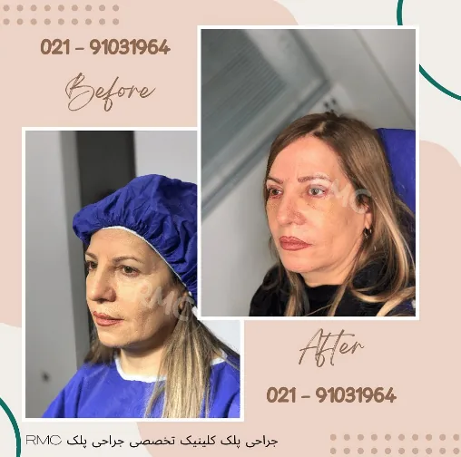 جراحی پلک پایین
