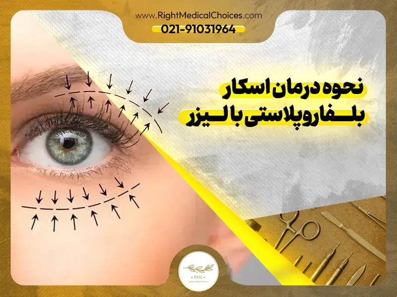 نحوه درمان اسکار بلفاروپلاستی با لیزر
