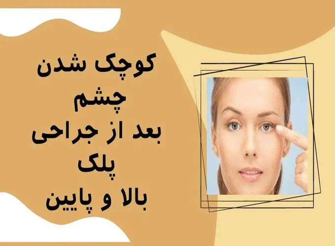 کوچک شدن چشم