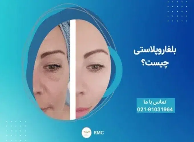 دلایل انجام درمان افتادگی پلک با بلفاروپلاستی