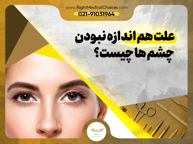 علت هم اندازه نبودن چشم ها چیست؟