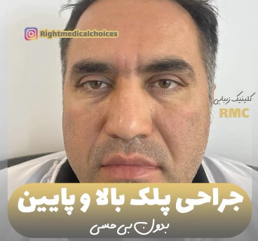 جراحی پلک پایین