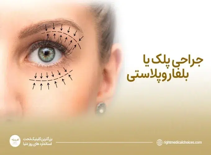 معرفی جراحی پلک (بلفاروپلاستی)