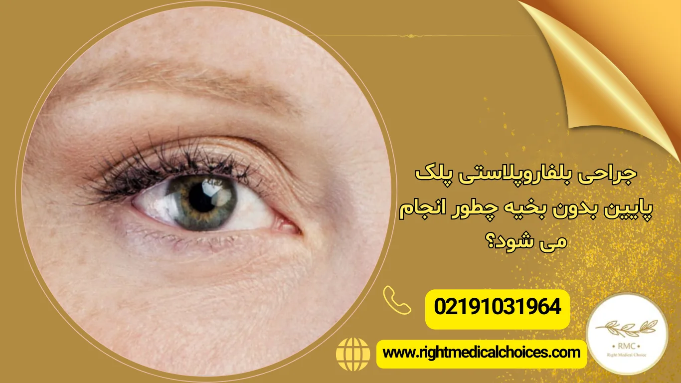 جراحی بلفاروپلاستی پلک پایین مدرن