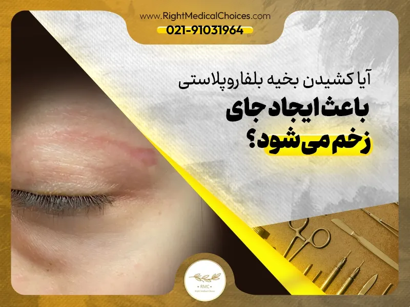 آیا کشیدن بخیه بلفاروپلاستی باعث ایجاد جای زخم می‌شود؟