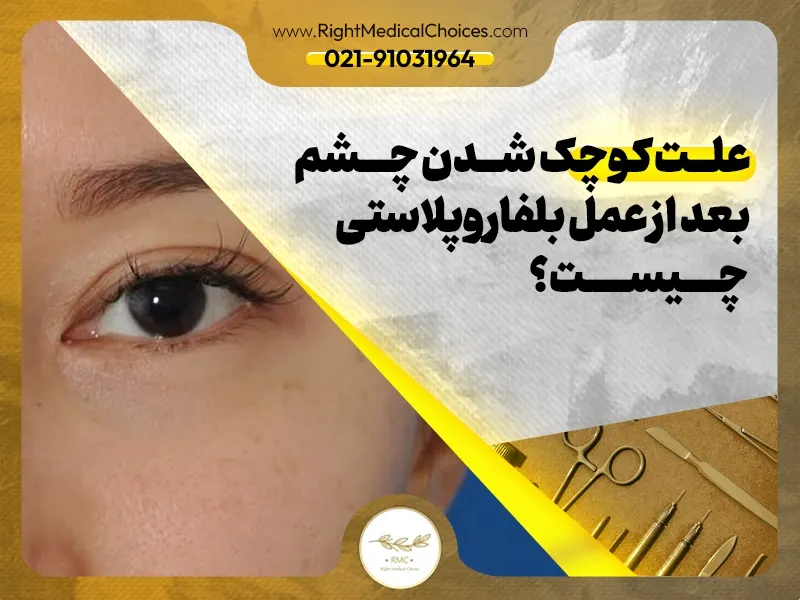 علت کوچک شدن چشم بعد از عمل بلفاروپلاستی چیست؟