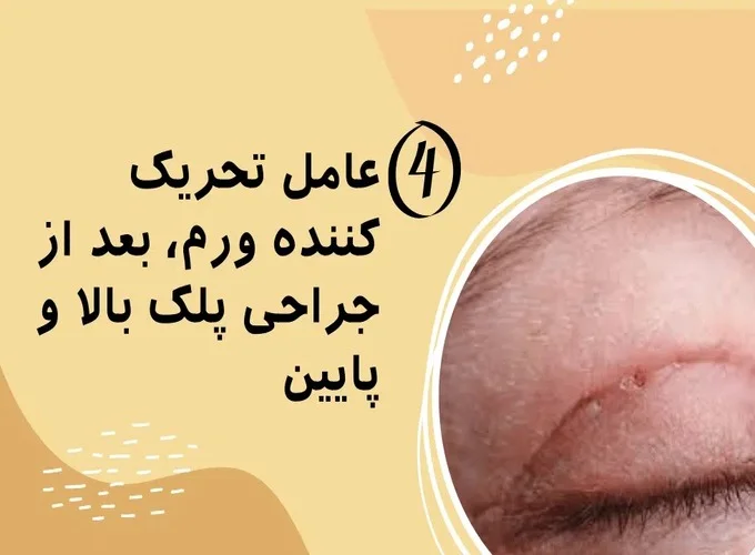 تورم و کبودی چشم بعد از جراحی پلک بالا