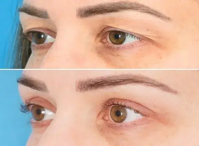 مشاهده نمونه‌کارهای جراح پلک