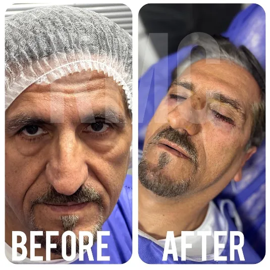 جراحی پلک پایین