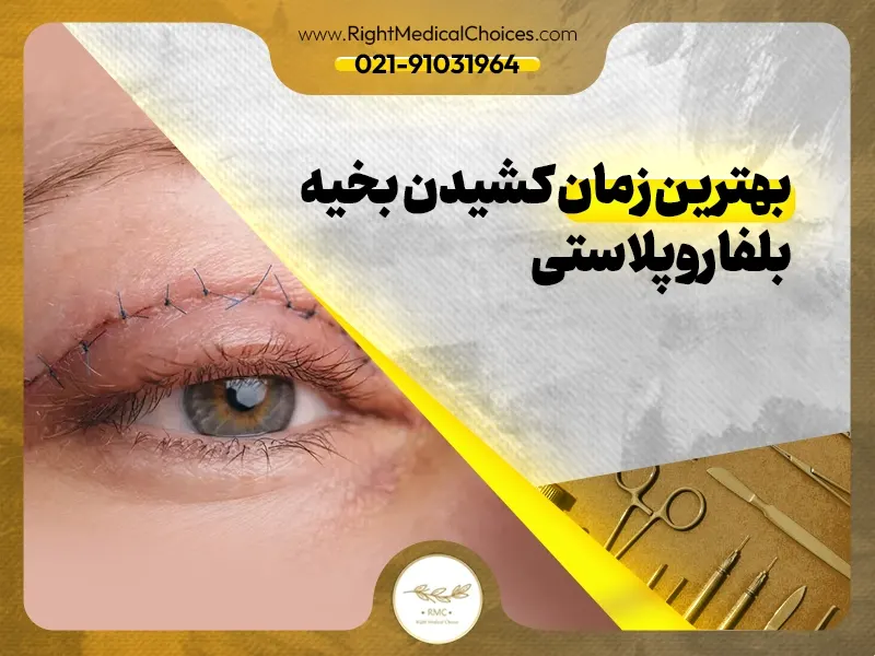 بهترین زمان کشیدن بخیه بلفاروپلاستی