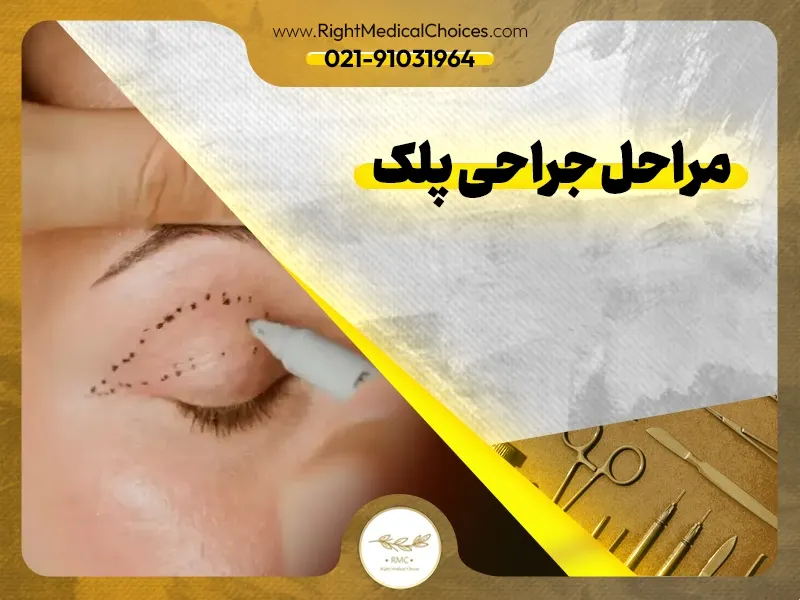 مراحل جراحی پلک