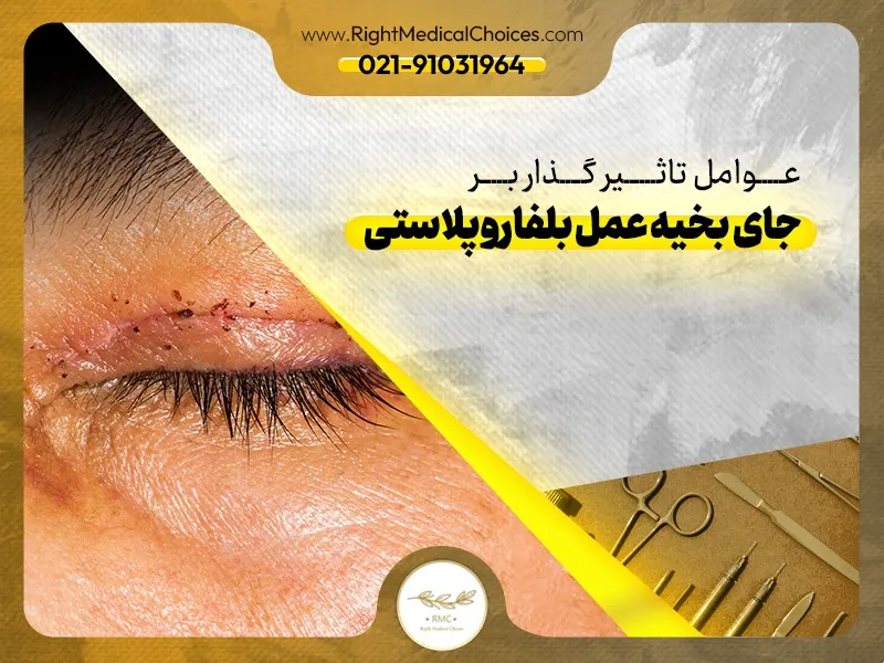 عوامل تاثیر گذار بر جای بخیه عمل بلفاروپلاستی